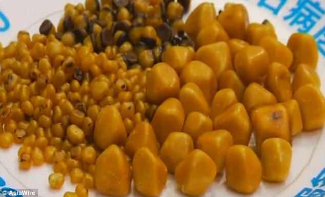 Mê đồ chiên, người phụ nữ mang trong mình 468 viên sỏi mật